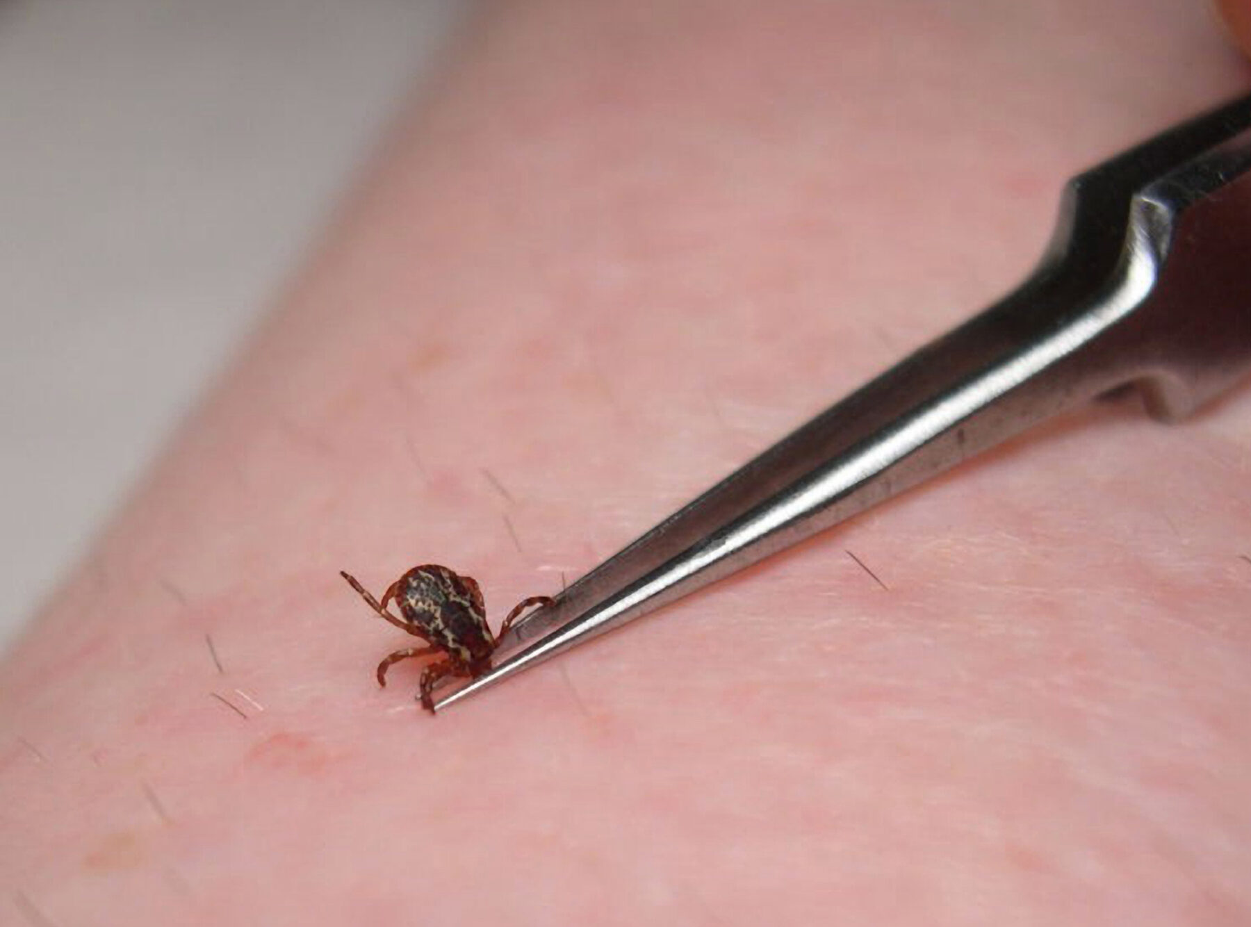 Tick removal with tweezers